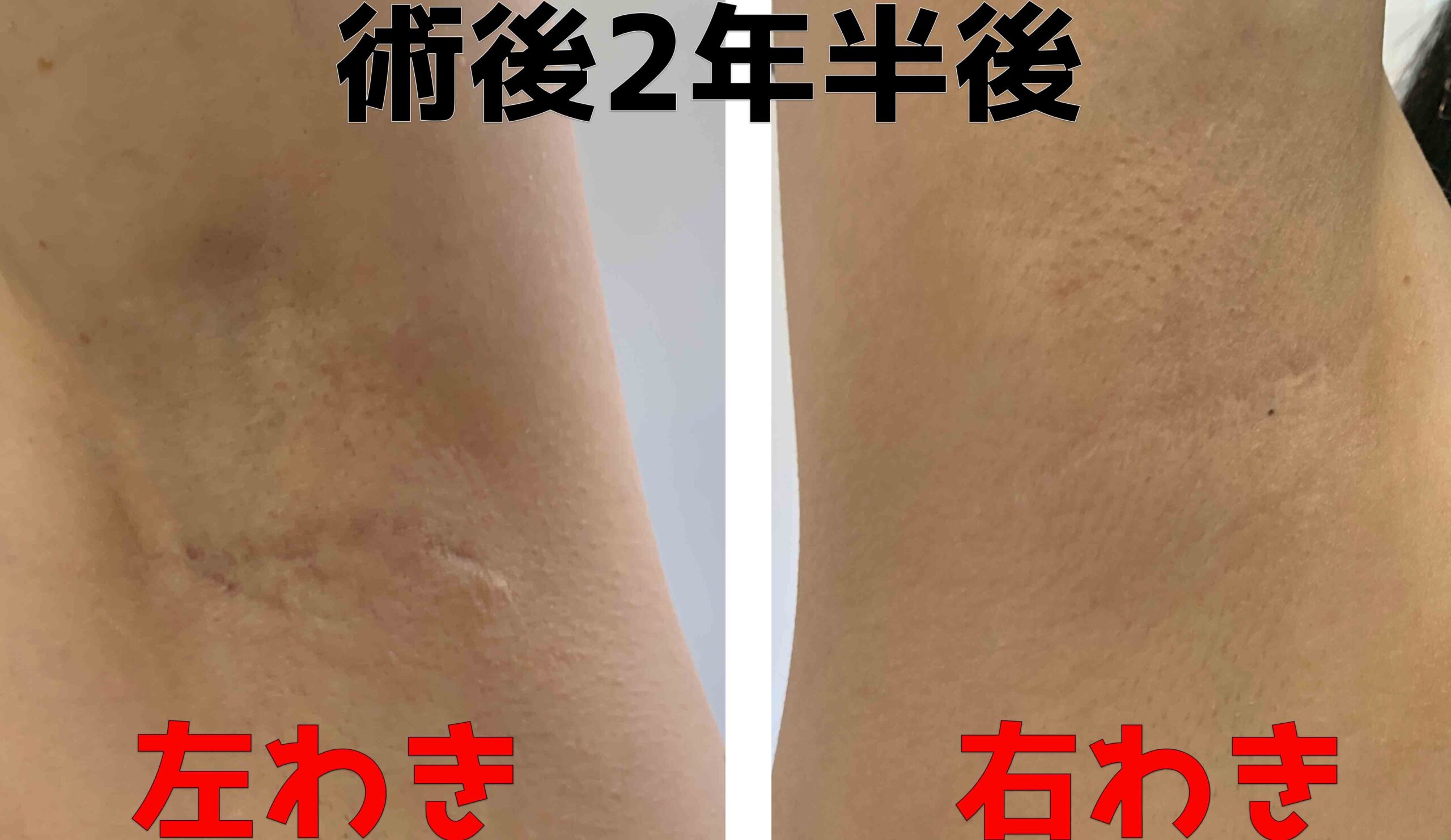 ワキガ手術後のキズは 術後2年半後の傷跡 効果ない あり 主婦めせん